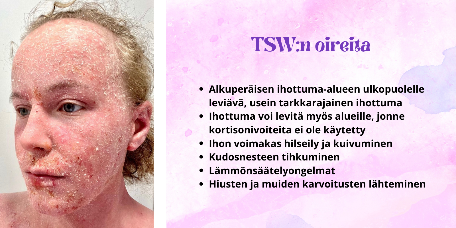 TSW ihon oireiden helpottaminen